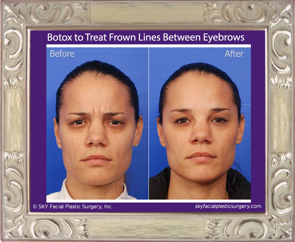 Botox to treat frown lines between eyebrows