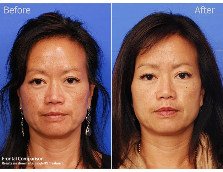 IPL Treatments San Diego — SKY Facial Plastic Surgery