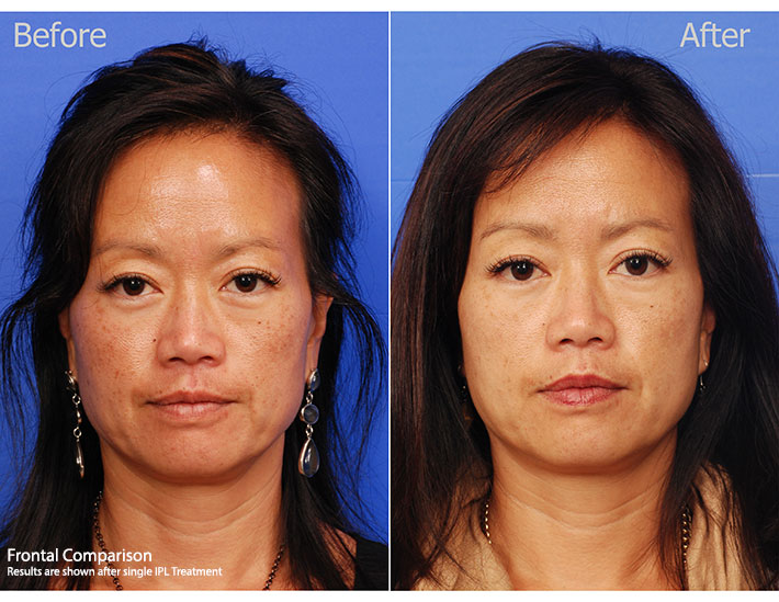 Frontal-Comparison2.jpg