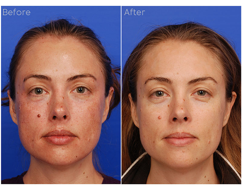 Frontal-Comparison1.jpg