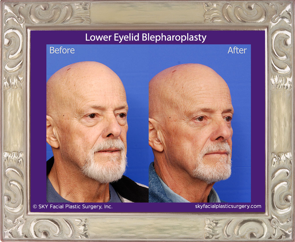 Transconjunctival Lower Lid Blepharoplasty with Skin Pinch