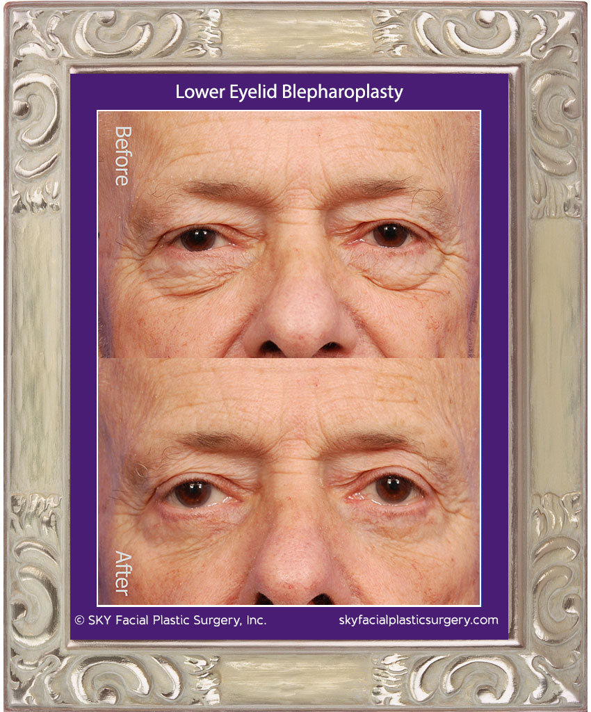 Transconjunctival Lower Lid Blepharoplasty with Skin Pinch