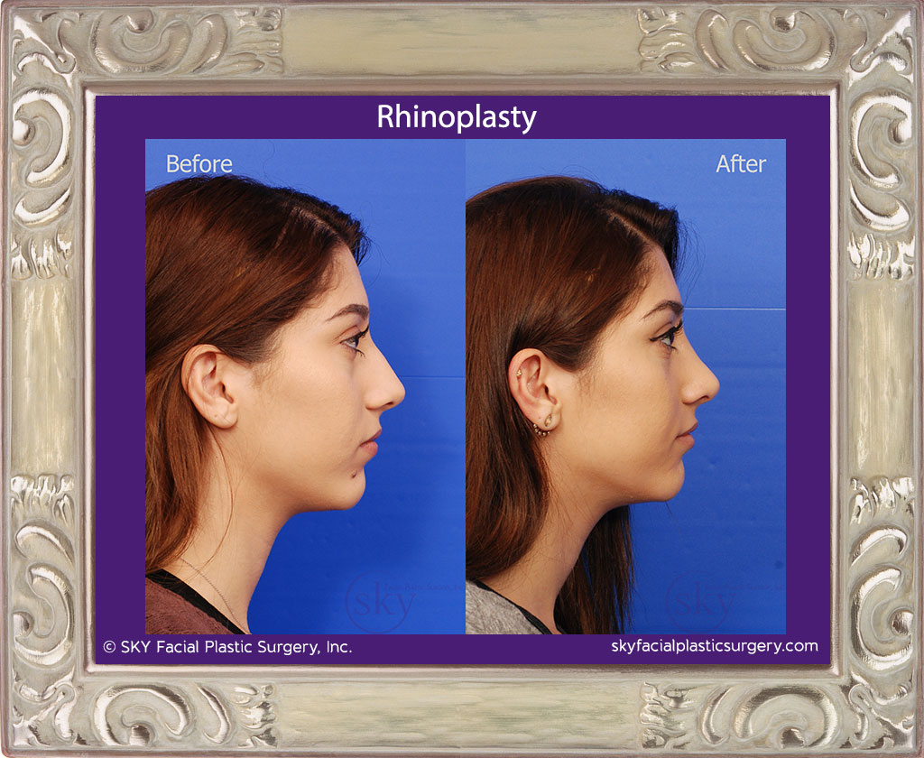 Rhinoplasty