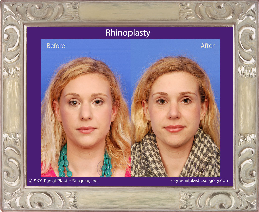 Rhinoplasty