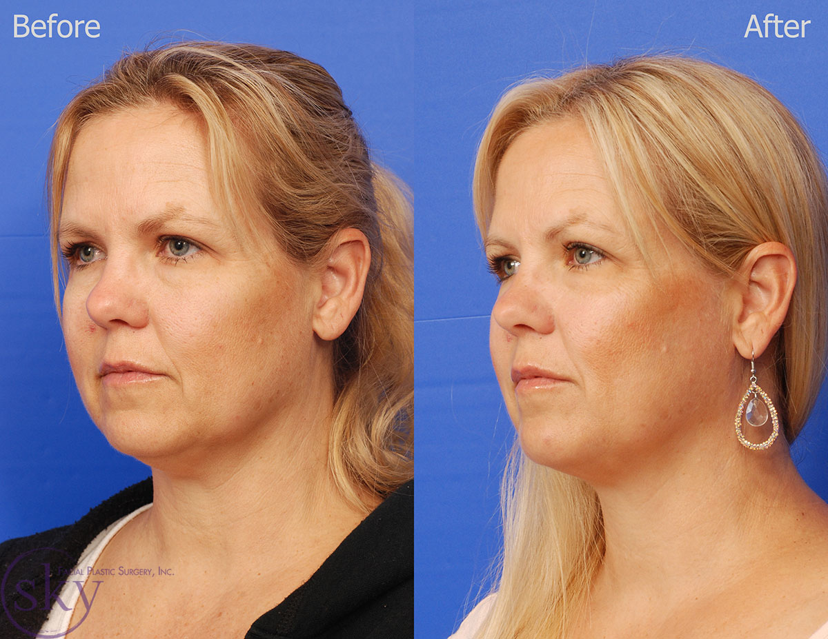 Kybella - non-surgical double chin removal