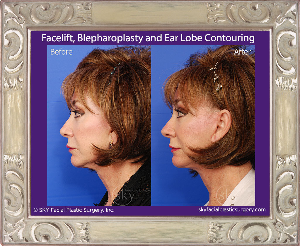 Facelift, blepharoplasty and ear lobe contouring