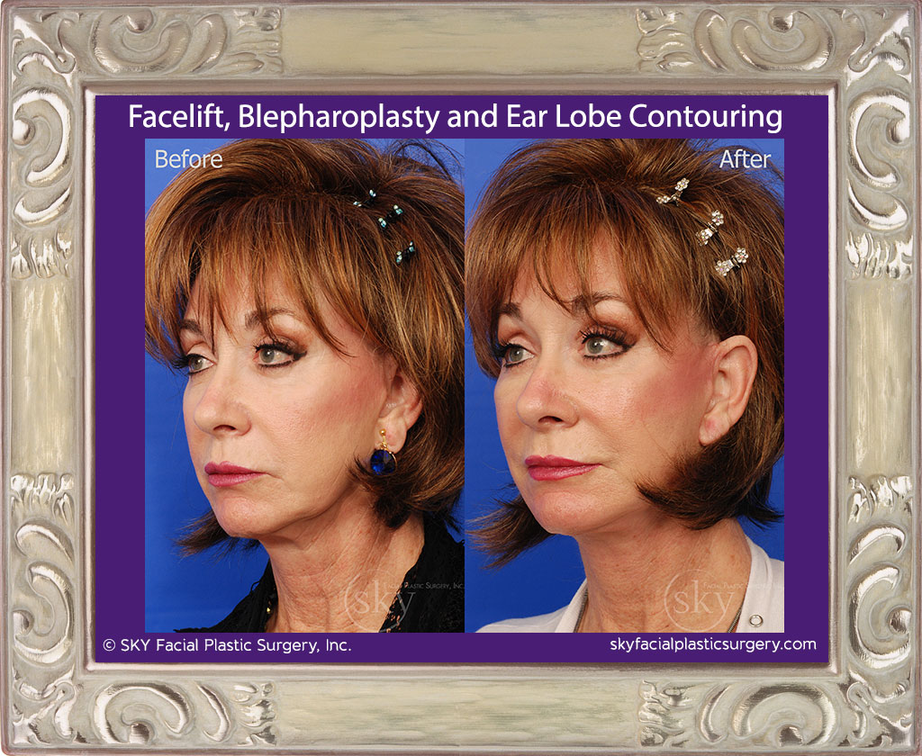 Facelift, blepharoplasty and ear lobe contouring