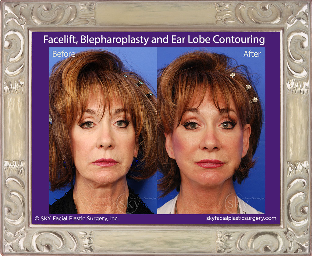 Facelift, blepharoplasty and ear lobe contouring