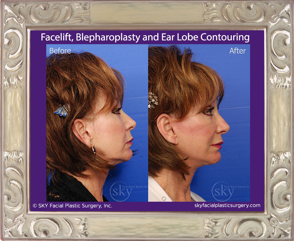 Facelift, blepharoplasty and ear lobe contouring