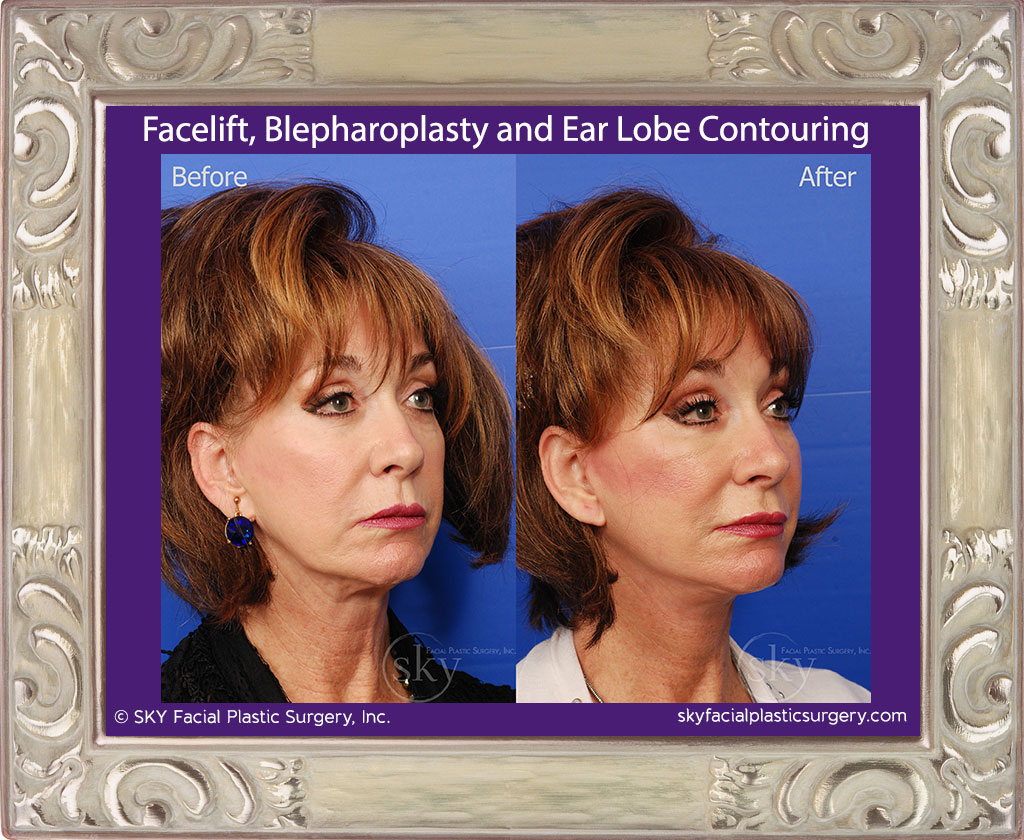 Facelift, blepharoplasty and ear lobe contouring