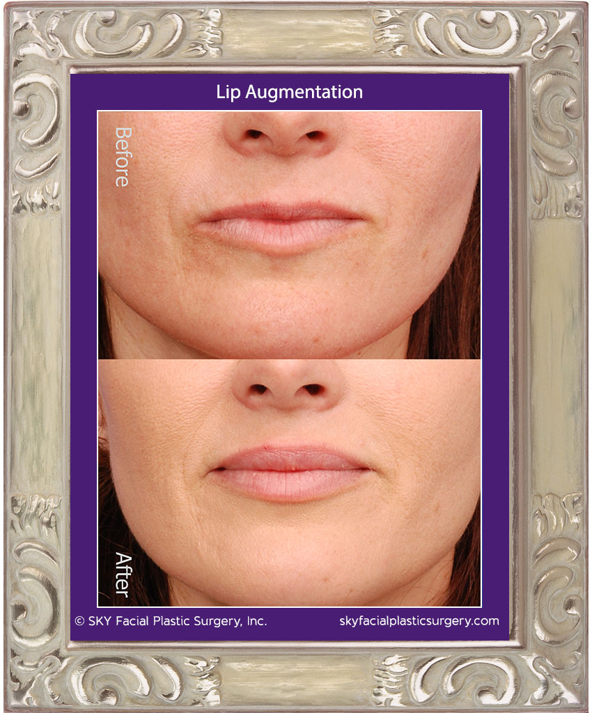 Juvederm lip augmentation