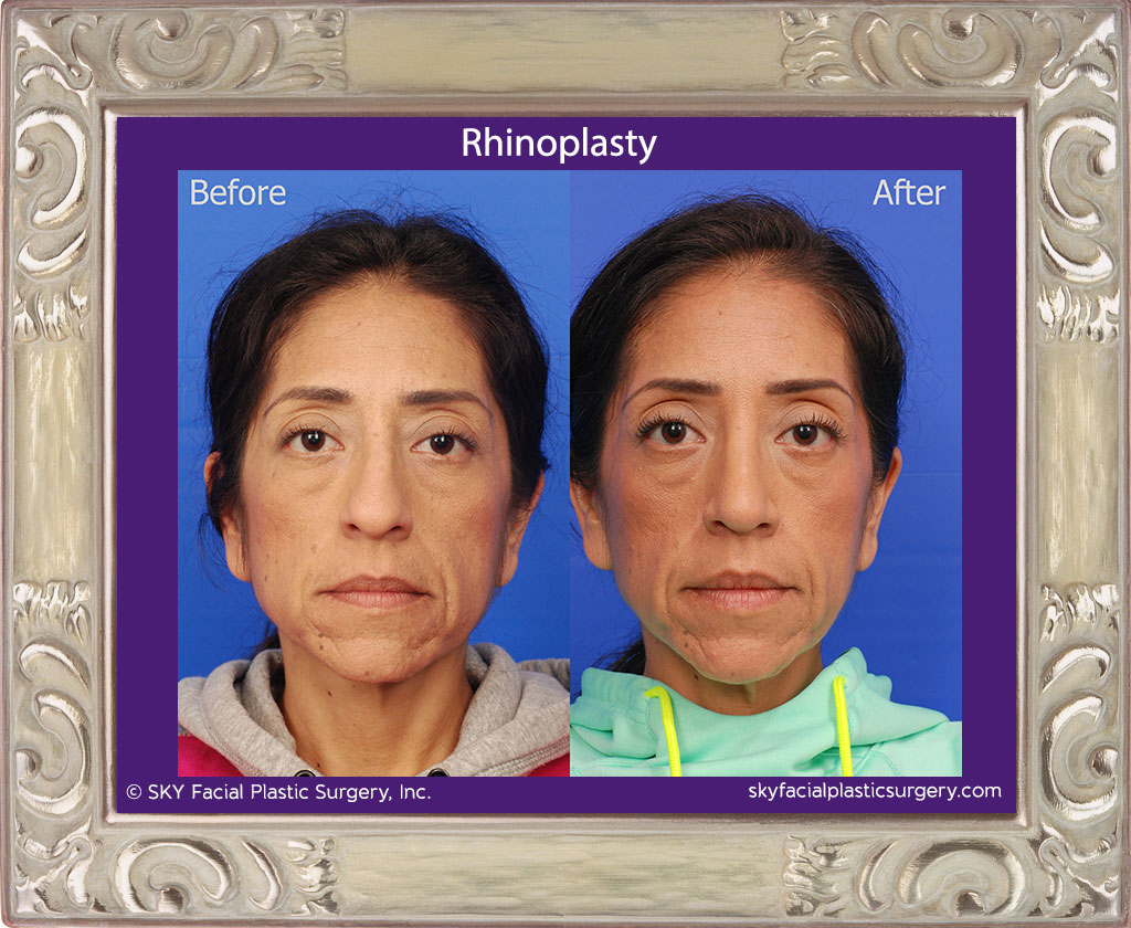 Cosmetic rhinoplasty