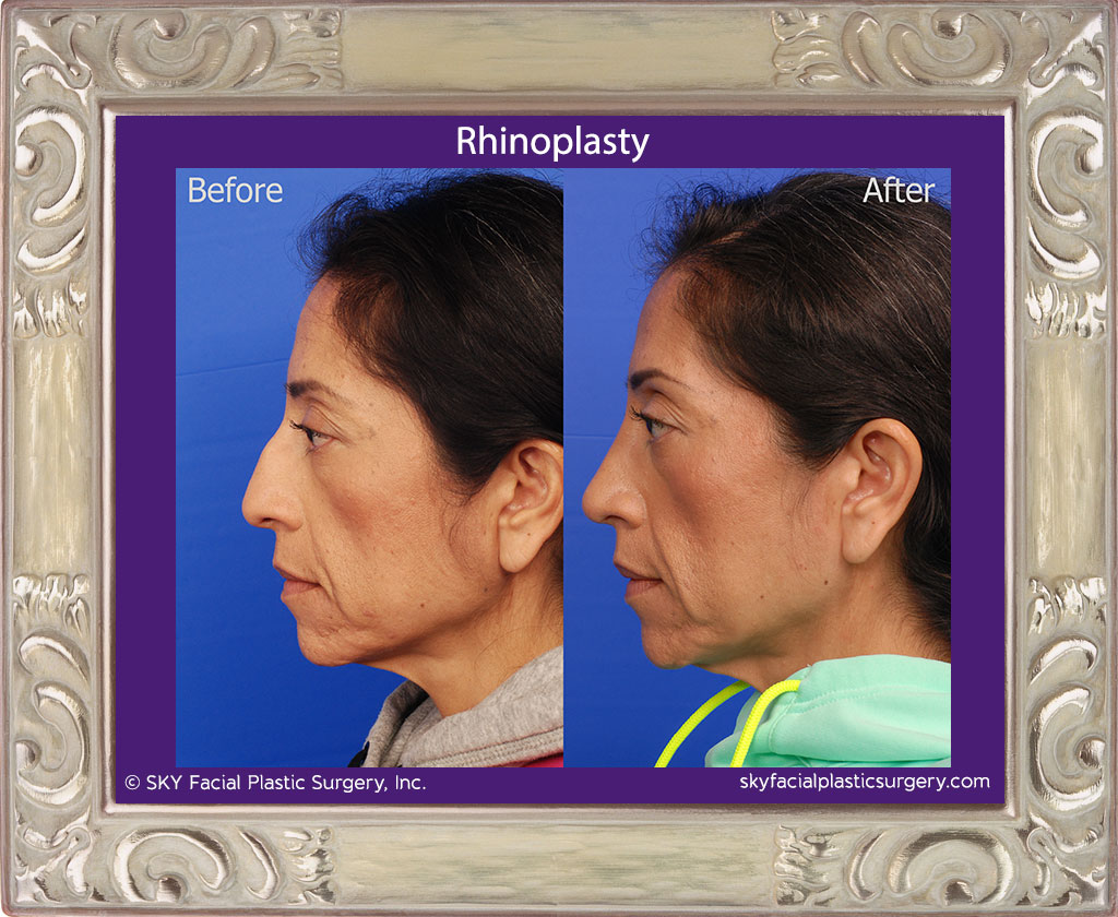 Cosmetic rhinoplasty - Bump removal