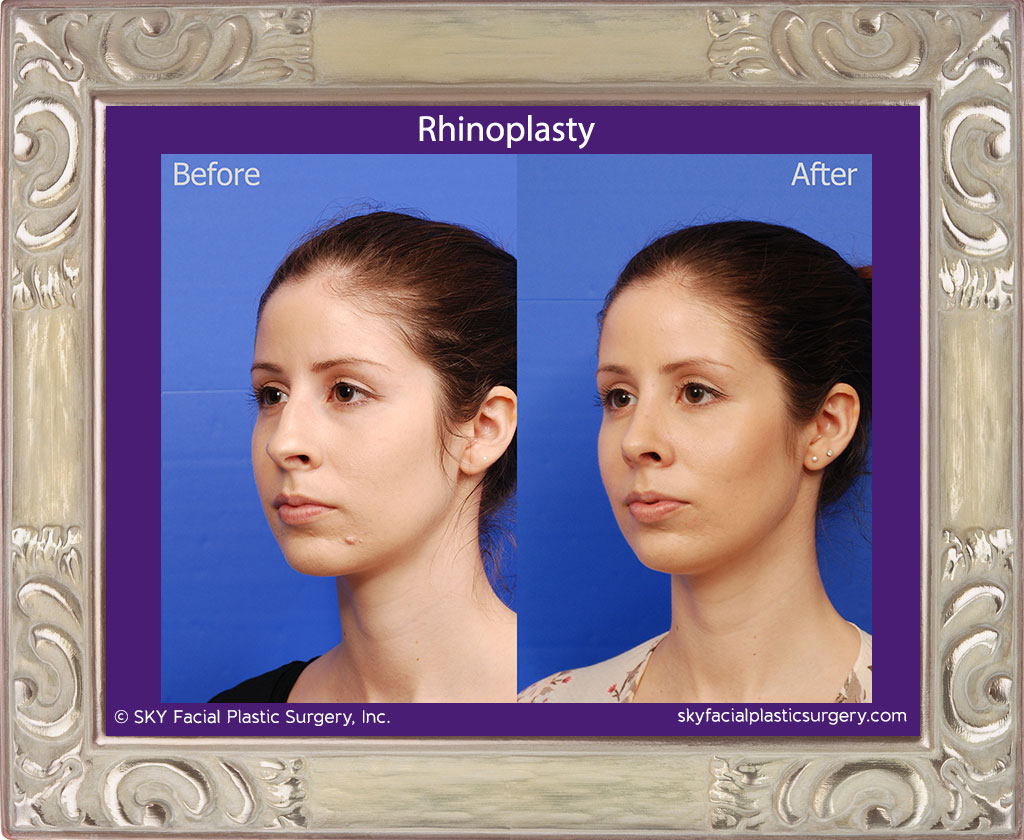 Rhinoplasty - Cosmetic