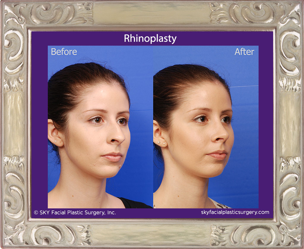 Rhinoplasty - Cosmetic