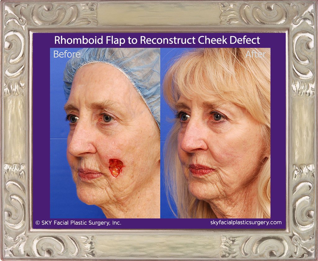 This woman had basal cell carcinoma in two spots along the left cheek. She had a dermatologic surgeon remove the cancer. The resulting defect is shown as the "before" picture. Dr. Yoo performed a rhomboid flap reconstruction of the defect. Results are shown one year after surgery.