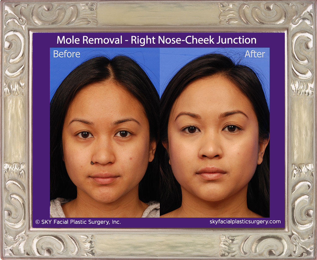 Mole Removal - Right Nose-Cheek Junction