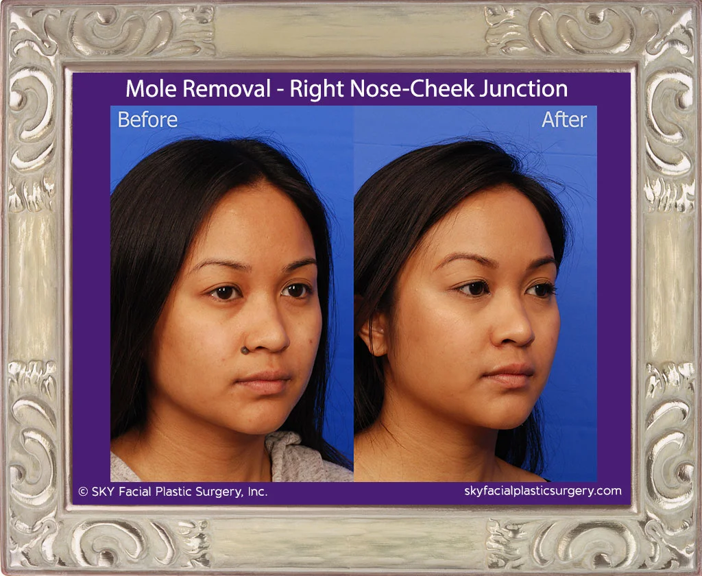Mole Removal | San Diego — SKY Facial Plastic Surgery