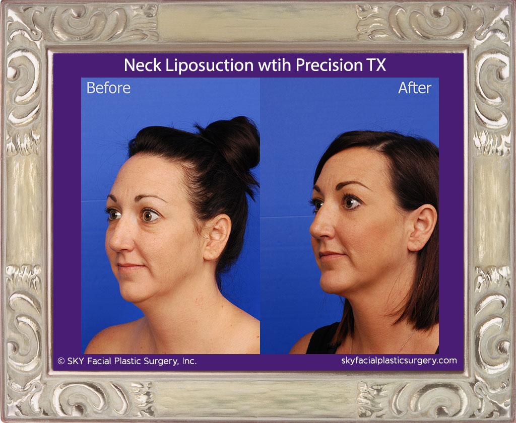 Neck liposuction with Precision TX