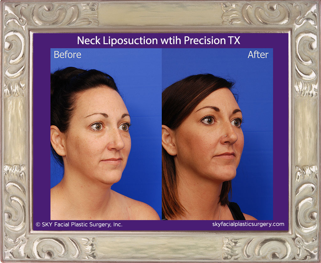 Neck liposuction with Precision TX