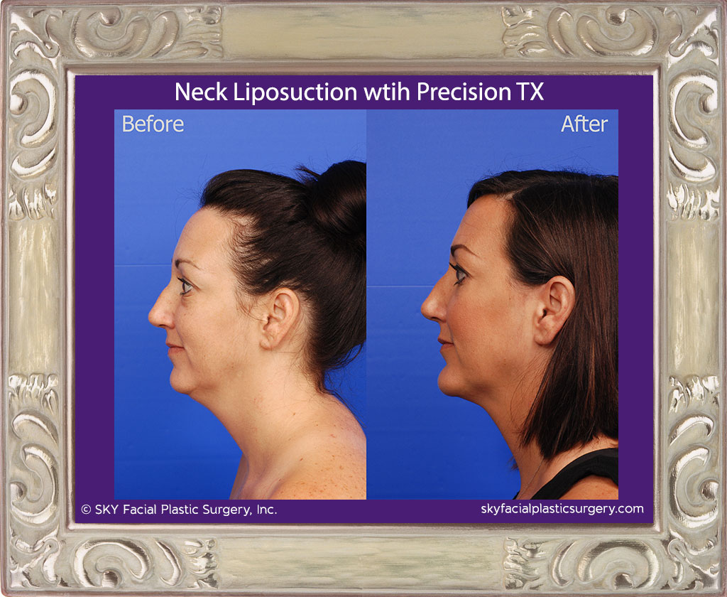 Neck liposuction with Precision TX