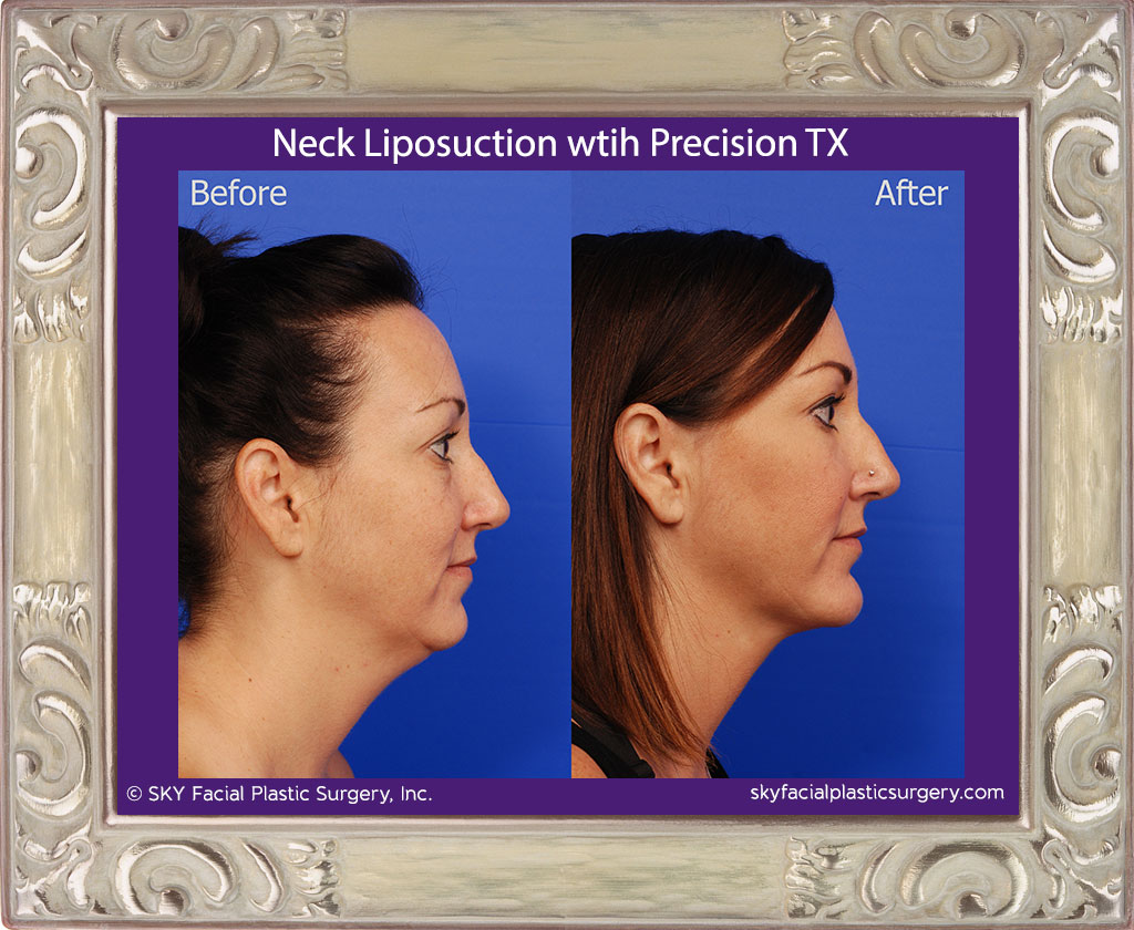 Neck Liposuction with Precision TX