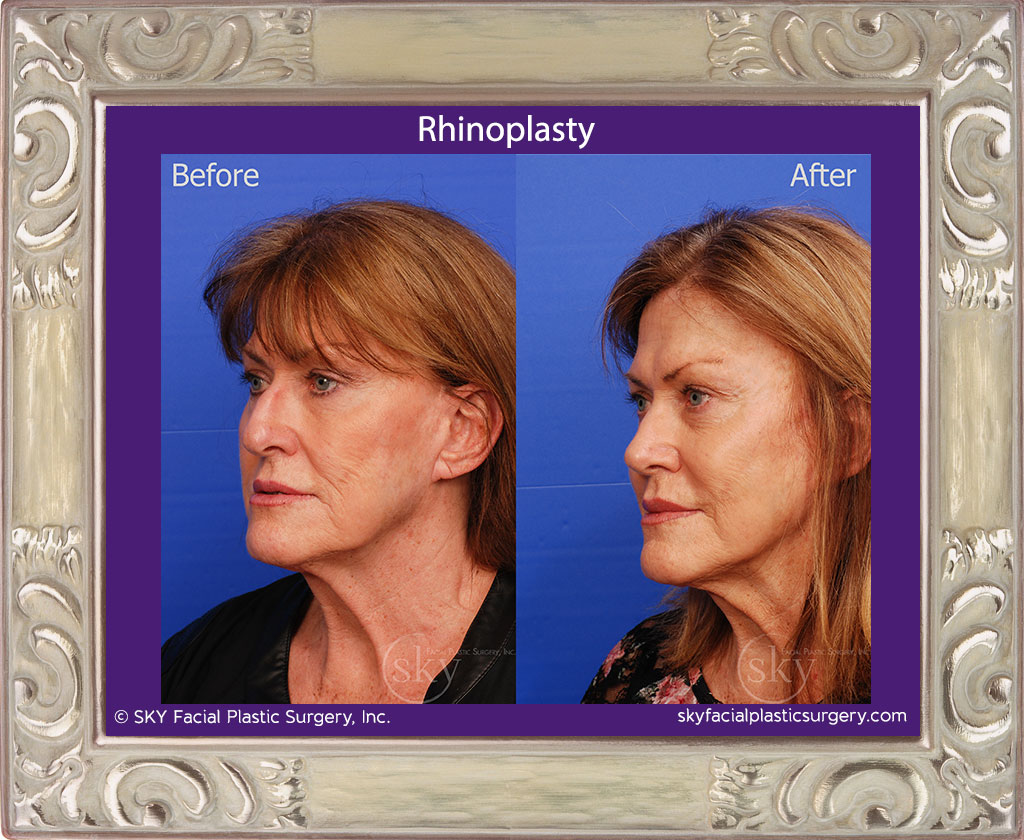 Rhinoplasty - Cosmetic