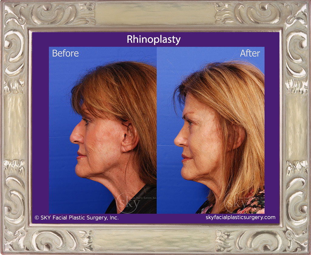 Copy of Rhinoplasty - Cosmetic