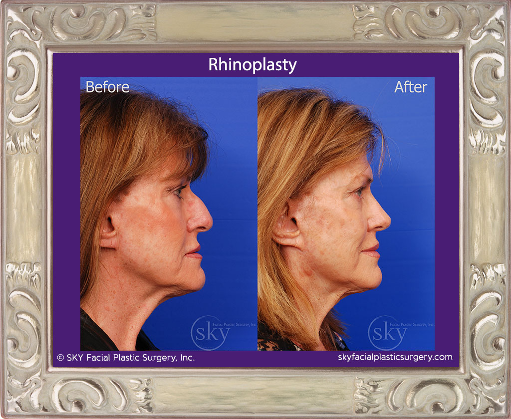 Rhinoplasty - Cosmetic