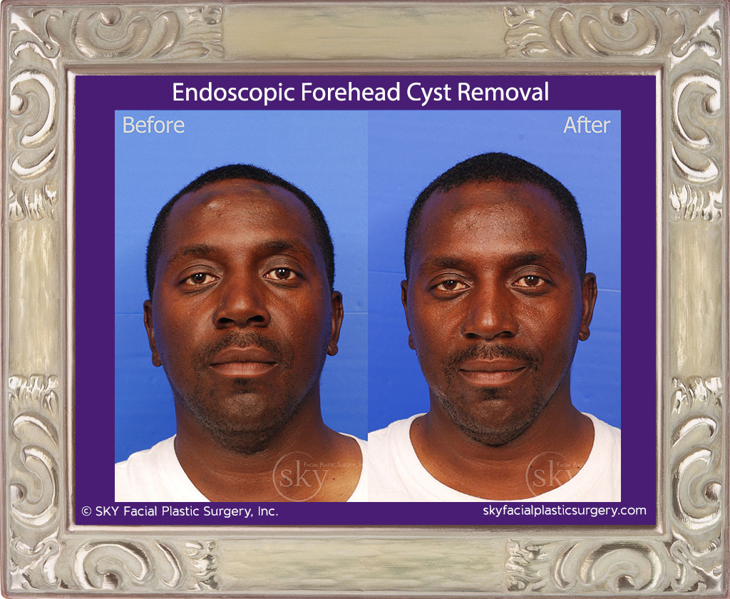 Scarless Endoscopic Forehead Cyst Removal