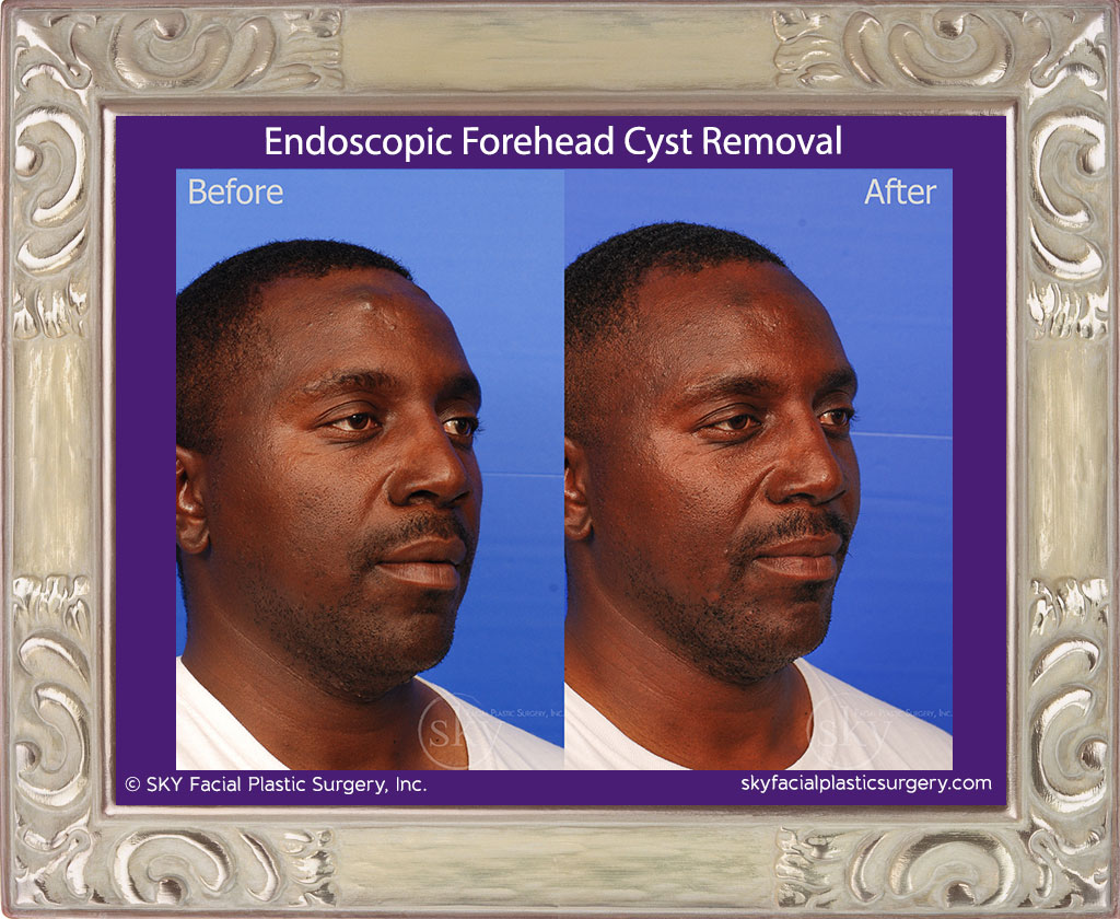 Scarless Endoscopic Forehead Cyst Removal