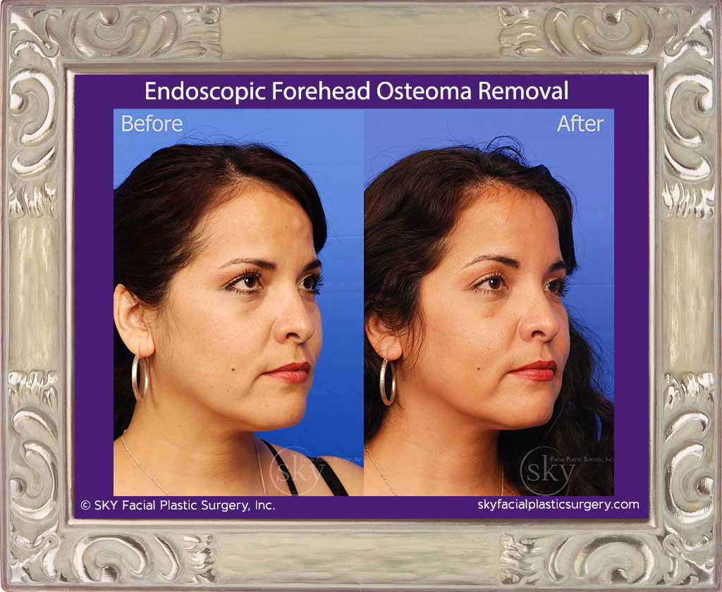 Endoscopic Forehead Osteoma Removal