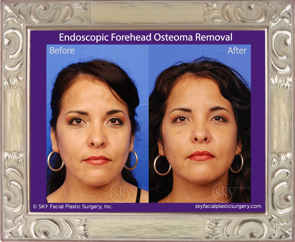 Endoscopic Forehead Procedures San Diego Lipoma Osteoma Brow — Sky