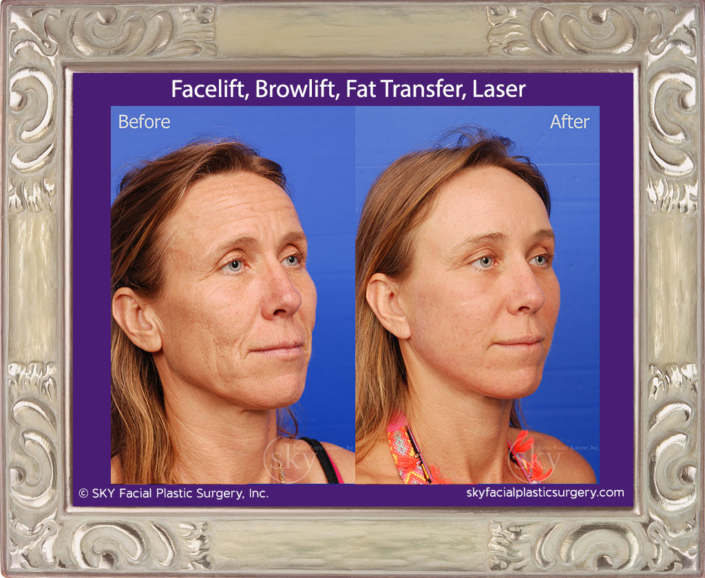 Facelift, Browlift, Fat Transfer, Laser