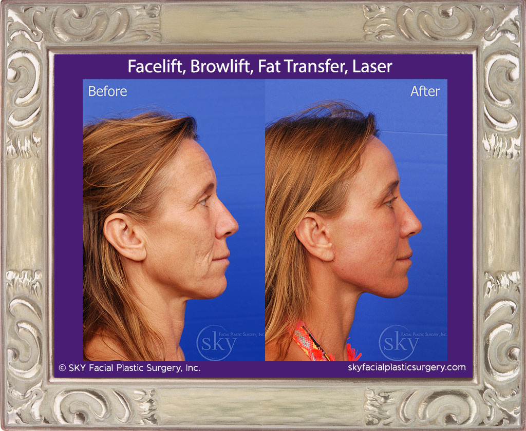 Facelift, Browlift, Fat Transfer, Laser