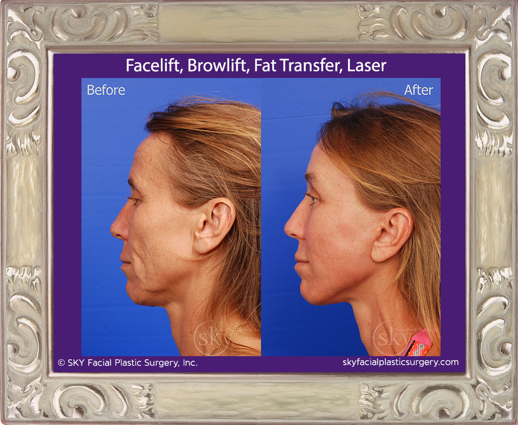 Facelift, Browlift, Fat Transfer, Laser