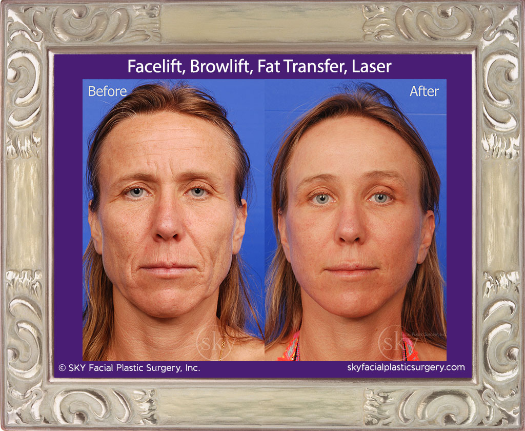 Facelift, Browlift, Fat Transfer, Laser