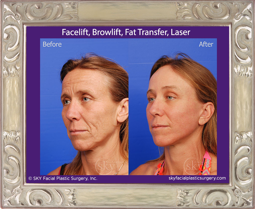 Facelift, Browlift, Fat Transfer, Laser