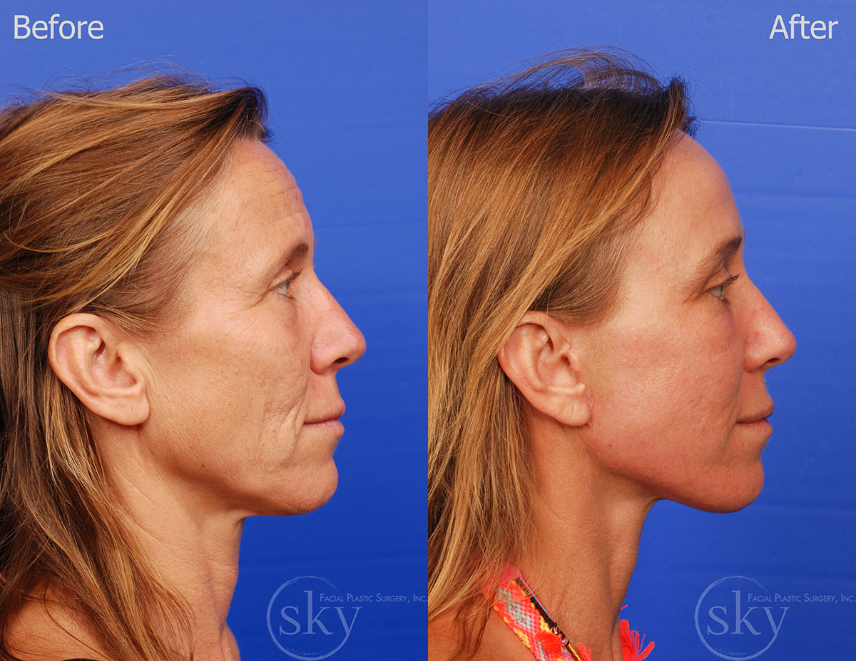 **Pearl fractional, Facelift, Browlift and Fat Transfer
