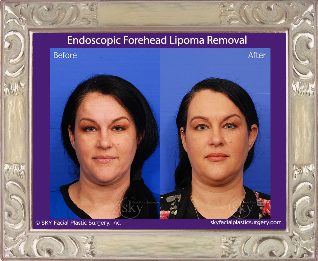 Endoscopic Forehead Lipoma Removal