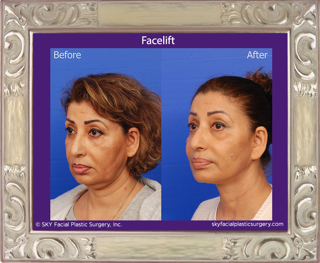 Lower Face and Necklift