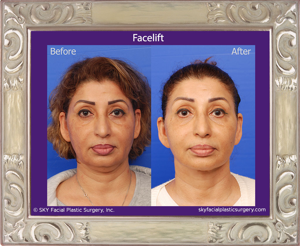 Lower Face and Necklift