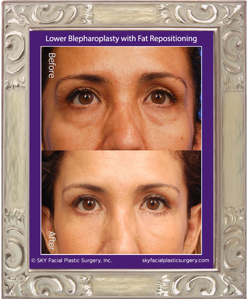 Lower lid blepharoplasty with Fat Repositioning