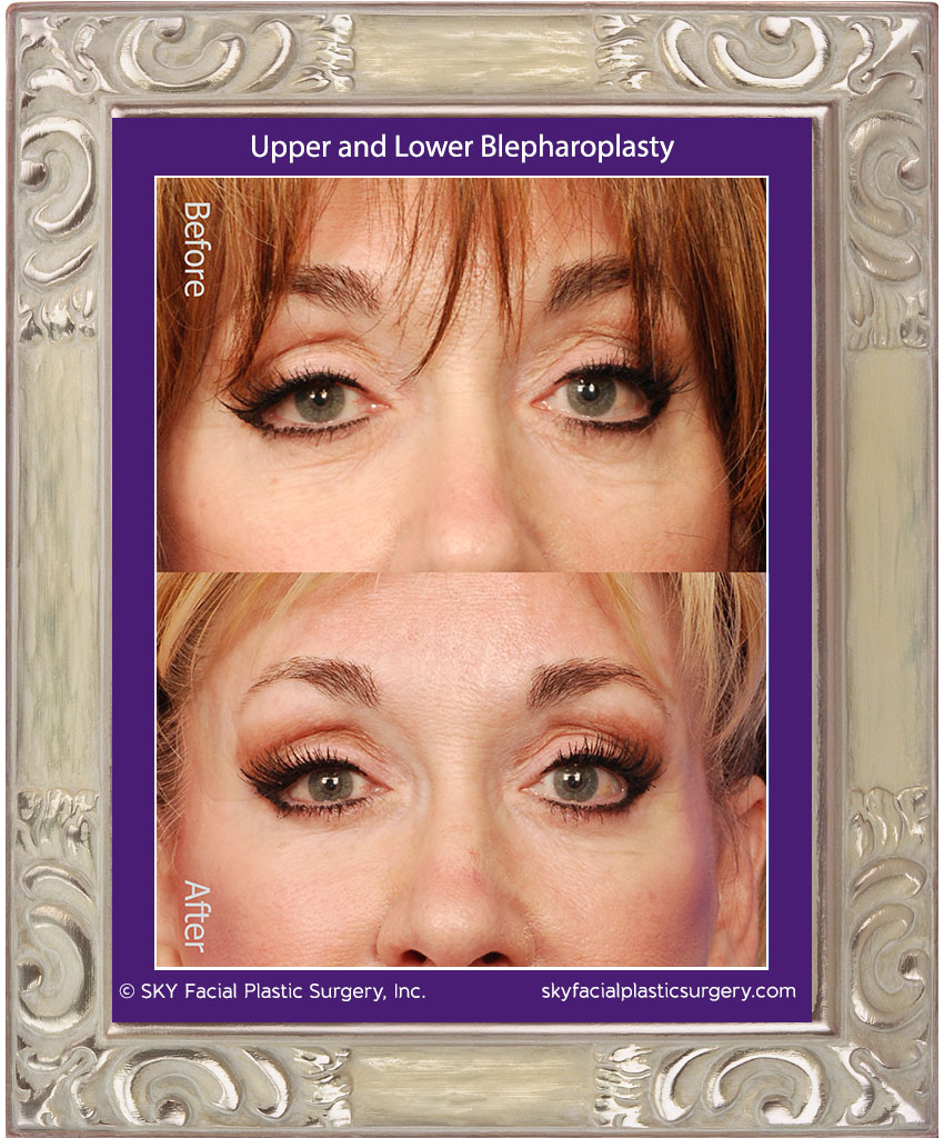 Traditional Upper and Lower Lid Blepharoplasty