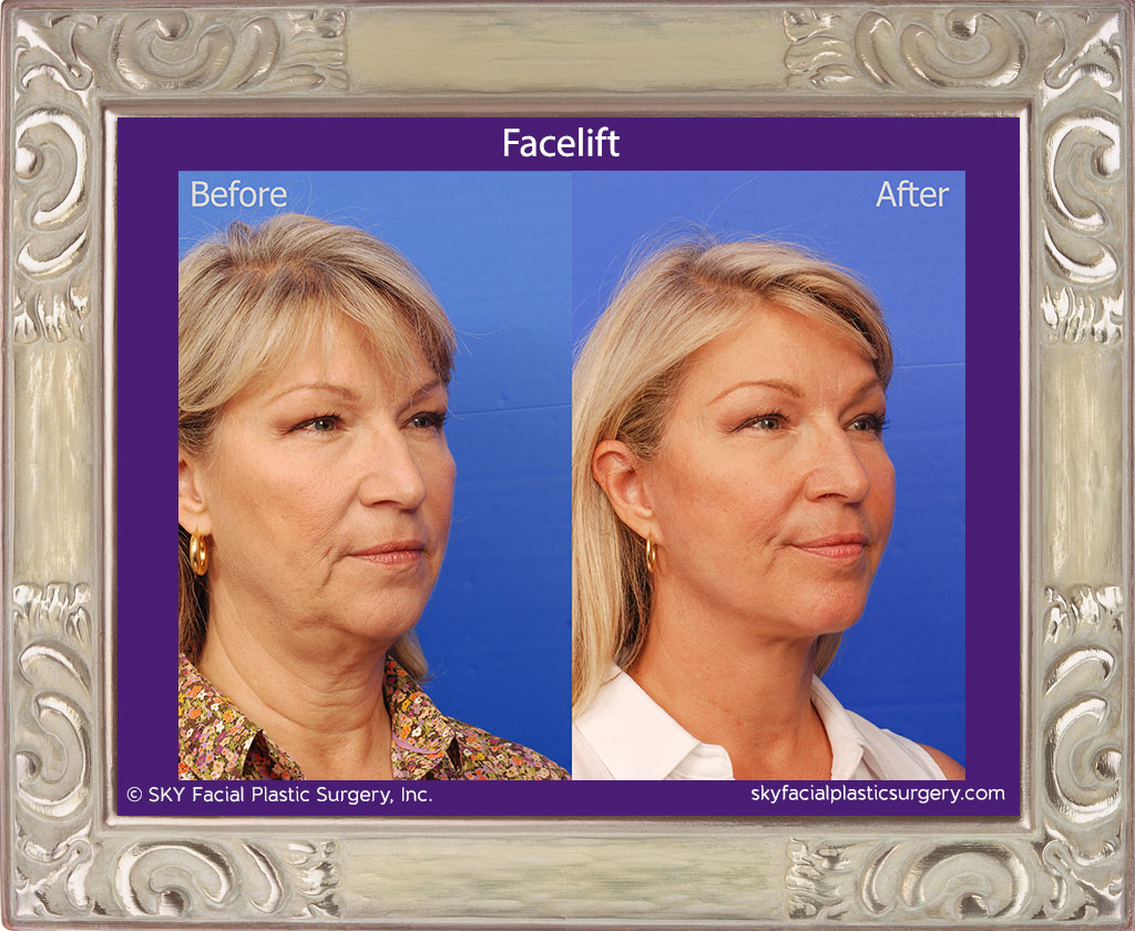 Facelift