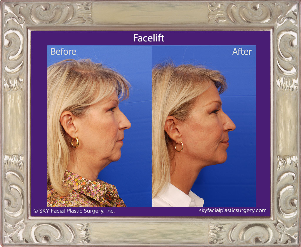 Facelift