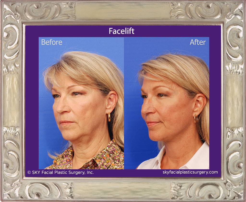 Facelift