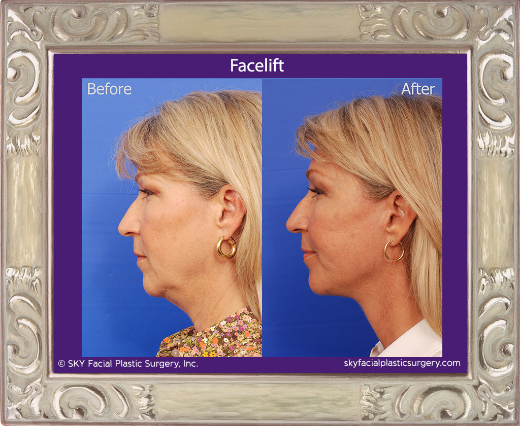 Facelift