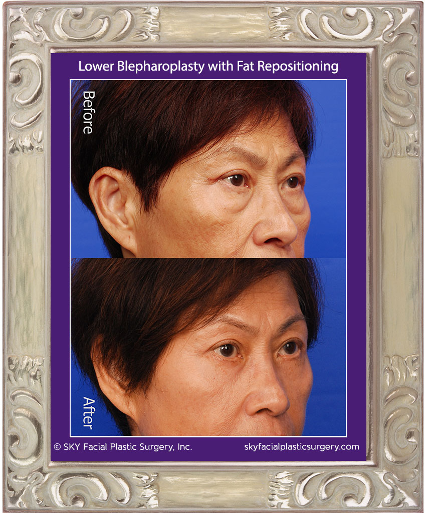 Lower Blepharoplasty with Fat Repositioning