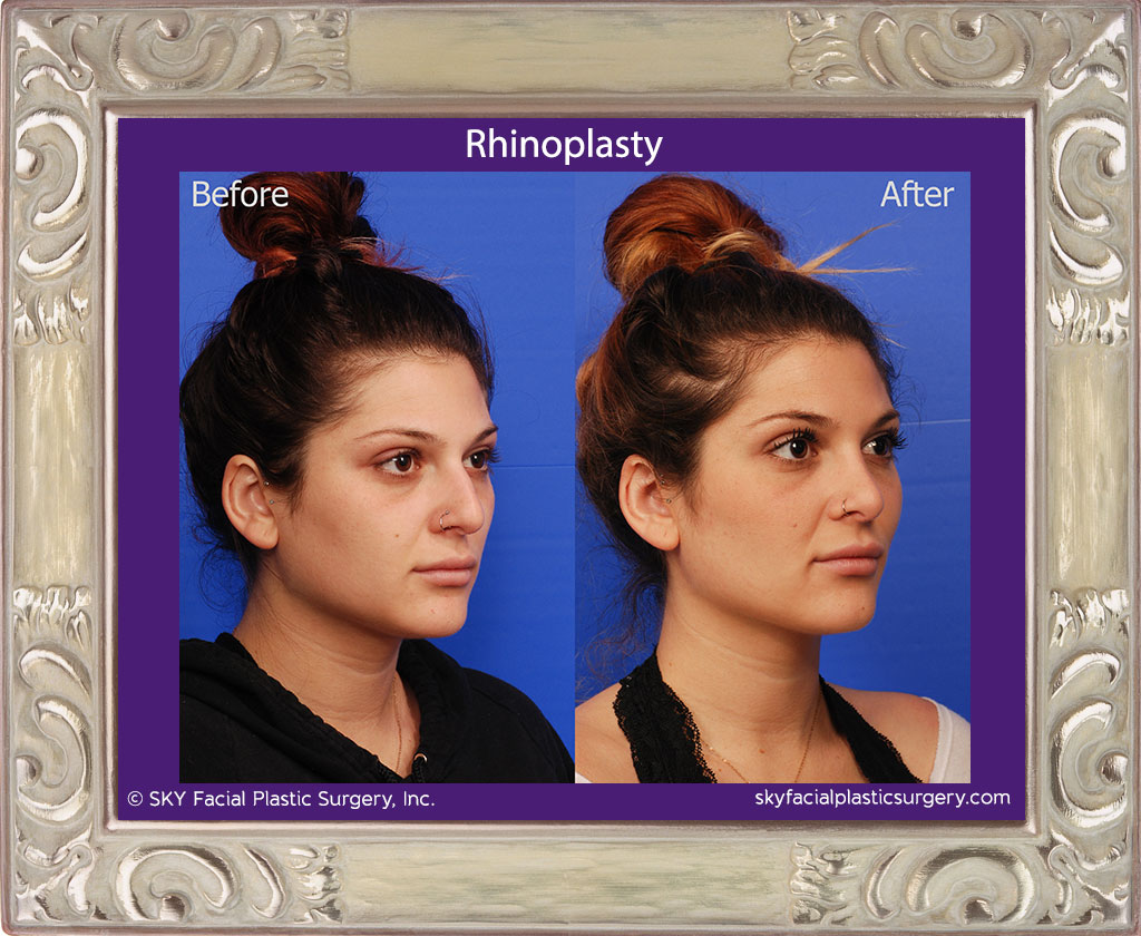 Rhinoplasty